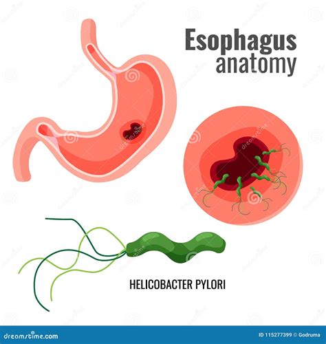helicobacter pylori esophagus diagram 